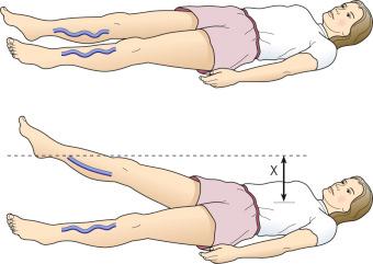 Figure 5.2, Venous outflow may also be assessed by elevating the leg until the superficial veins collapse and then measuring the distance (X) from the heart to the heel and comparing this measurement with the other leg.