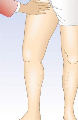 Figure 5.3, Cough test. The saphenofemoral junction (SFJ) is palpated while the patient coughs. Palpation of an impulse is indicative of SFJ insufficiency.