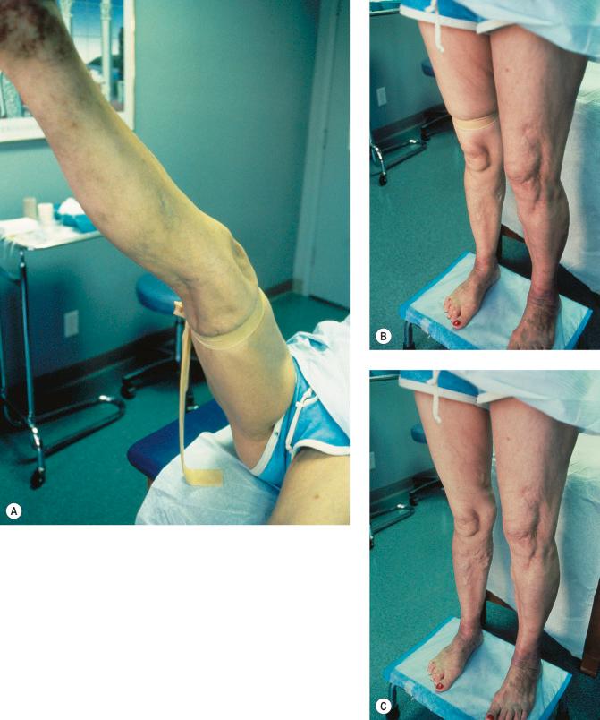 Figure 5.5, Brodie-Trendelenburg test. A, The proximal portion of the great saphenous vein is obstructed after the veins have emptied with the leg elevated. B, The distal veins are then observed after the patient stands. C, The veins are further inspected after the tourniquet is released. In this case, filling of the veins on standing and additional filling after tourniquet removal constitutes a double-positive test.