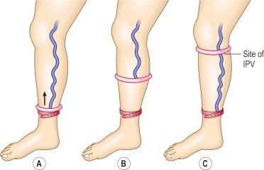 Figure 5.8, Device for the detection of incompetent perforating vein (IPV). A, Two rubber rings are placed around the ankle. B, The more proximally placed ring is slowly rolled upward. C, As it rolls above an IPV, the reflux of blood through the IPV causes an immediate distention of a superficial varix or the formation of a large bulge at the site of the IPV.