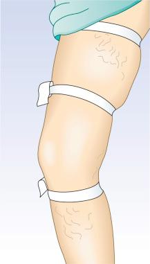 Figure 5.9, Comparative tourniquet test. Distention of the varices in each segment of the leg when the patient ambulates implies the presence of incompetent perforating veins in each segment.