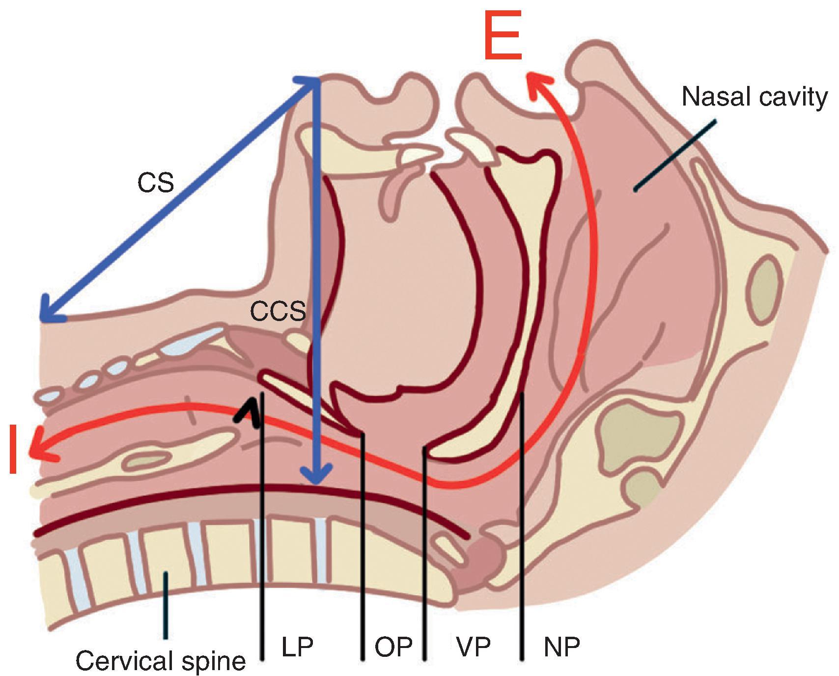 Fig. 18.1, The upper airway pharyngeal compartments: the nasopharynx (NP) , velopharynx (VP) , oropharynx (OP) , and laryngopharynx (LP) . The anatomic sites of UA soft tissue collapse in an unconscious patient are the soft palate, the most important being the tongue and epiglottis. The generic markers of chin elevation (by head extension or mandibular advancement) are the increase of the chin–sternum (CS) and chin–cervical spine (CCS) distance. The nasal ventilation route (with the mouth closed)— red line —cumulates all the potential obstruction sites: nasal cavities, NP, VP, OP, LP, and the glottis in expiration (E) and inspiration (I) .