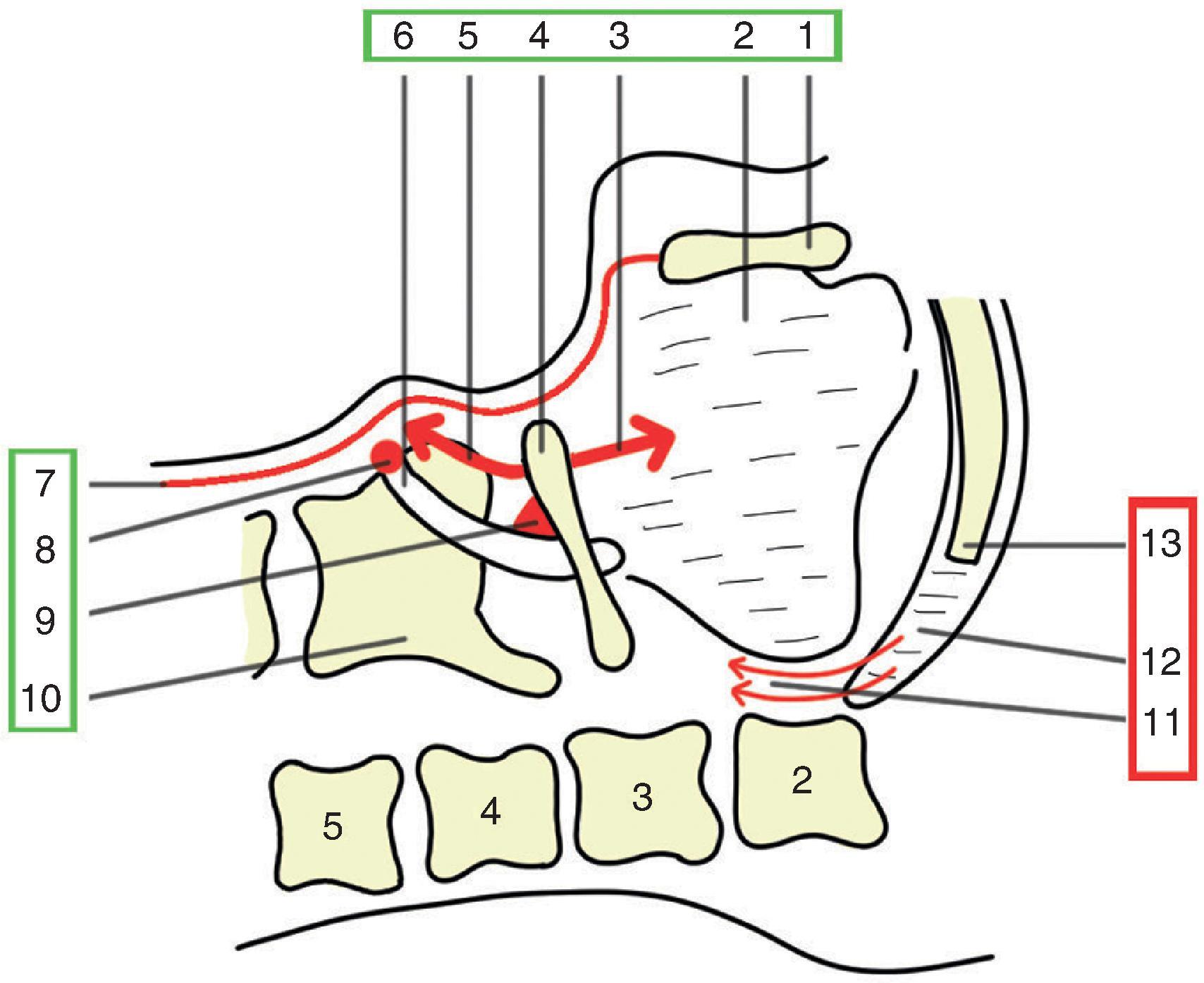 Fig. 18.2, Upper airway soft and solid tissue connections essential for the relief of the airway obstruction by airway maneuvers: 1 , mandible; 2 , tongue (genioglossus, hyoglossus); 3 , suprahyoid muscles (digastric, stylohyoid, geniohyoid, mylohyoid); 4 , hyoid bone; 5 , infrahyoid muscles (sternohyoid, sternothyroid, thyrohyoid, omohyoid); 6 , epiglottis; 7 , platysma; superficial and middle cervical fascia; 8 , thyroepiglottic ligament (works as a hinge); 9 , hyoepiglottic ligament (works as a lever); 10 , thyroid; 11 , palatoglossus, palatopharyngeus; tensor veli palate; 12 , soft palate; 13 , hard palate. Green boxes: direct soft–solid tissue connections with consistent response to airway maneuvers. Red box: indirect soft–solid tissue connections with inconsistent response to airway maneuvers (bypassed by the use of oropharyngeal airway and nasopharyngeal airway).