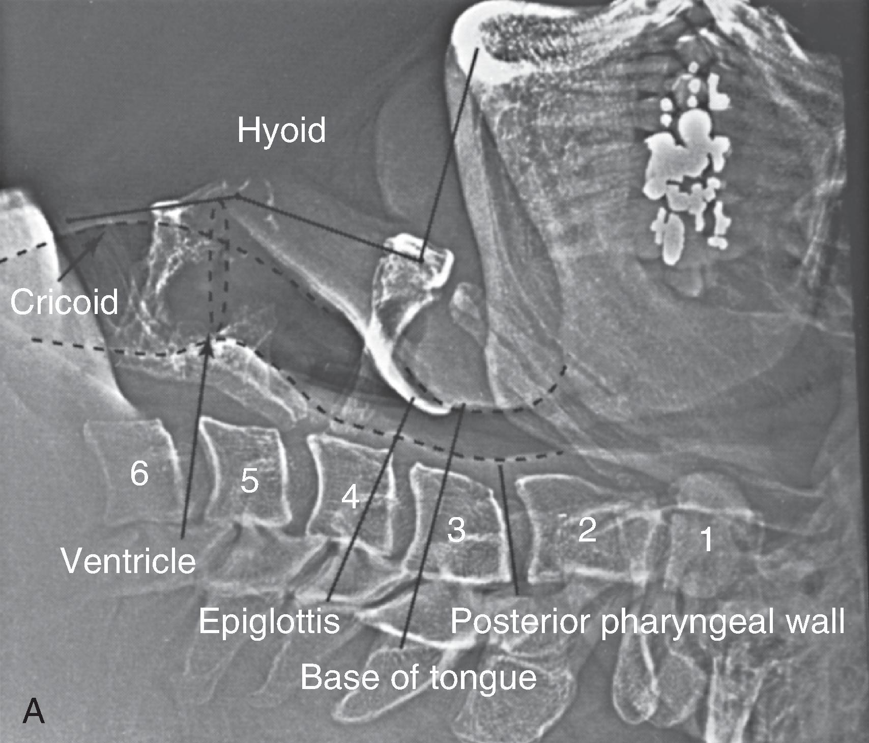 Fig. 18.3, (A) Lateral xenogram of the head and neck shows the extended position (head extension) in an awake and supine patient. The mentum is superior to the hyoid bone, the base of the tongue and the epiglottis are farther from the posterior pharyngeal wall, and the thyroid and cricoid cartilages are at the C4–C5 level. The hyoid bone has been raised and elevated from C3–C4 to C2–C3. (B) The validated chin lift/head extension (CL/HE) is a two-handed technique applied in the sagittal plane with one hand on the chin and the other on the forehead/occiput to extend the head on the cervical spine at the occipito-atlanto-axial (OAA) joint, stretching the anterior neck structures. The objective marker of a CL/HE is the extension angle (EA) and the increase in the chin–sternum (CS) and chin–cervical spine (CCS) distance. Maximal EA corresponding to a maximal extension is 42 degrees in both men and women. MC, Mouth closed.