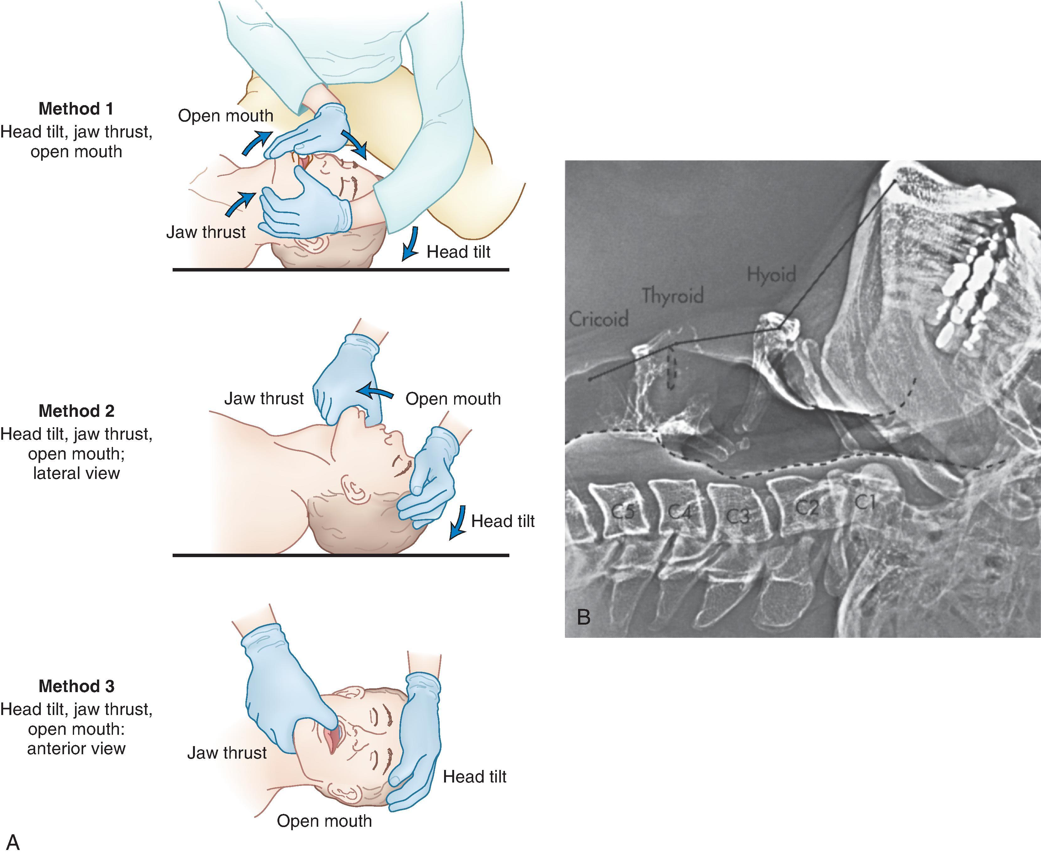 Fig. 18.5, The triple airway maneuver includes the head tilt/chin lift, jaw thrust, and open mouth. (A) Diagrams show three methods of performing the maneuver: (1) the head extended on the atlanto-occipital joint, (2) the mouth opened to take the teeth out of occlusion, and (3) the mandible lifted upward, forcing the mandibular condyles anteriorly at the temporomandibular joint. (B) Lateral xerogram of the head and neck shows the extended position with jaw protrusion. Notice that the mandibular incisors protrude beyond the maxillary incisors and that the mandibular condyles are subluxated anteriorly from the temporomandibular joint.