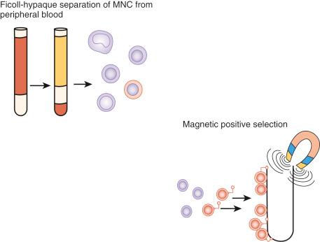 • Fig. 21.1, A, Ficoll-Hypaque separation of mononuclear cells (MNC) from peripheral blood. The separation of mononuclear cells from other cells (e.g., red blood cells) in the maternal circulation is demonstrated. A Ficoll-Hypaque gradient is used, separating the cells based on density. The mononuclear cell layer will have an increased concentration of fetal cells. B, Magnetic positive selection. Further separation in which the cells are stained with antibodies attached to ferrous beads known to be fetal cell specific. Magnetic cell separation then performed to select the labelled cells.