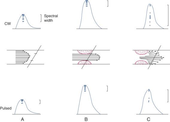 FIG 14.1, Comparison of sonograms from continuous-wave (CW) and pulsed Doppler systems.