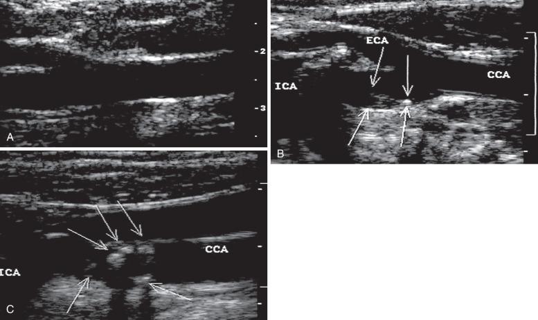 FIG 14.2, B-mode images from carotid duplex scan. (A) Normal bifurcation. (B) Moderate heterogeneous plaque with varying echogenicity. (C) Calcified lesion with high echogenicity and shadowing below the plaque. CCA, Common carotid artery; ECA, external carotid artery; ICA, internal carotid artery.