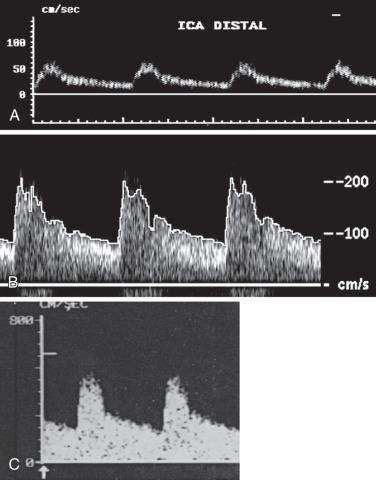 FIG 14.3, Doppler Sonograms From Carotid Duplex Scans.