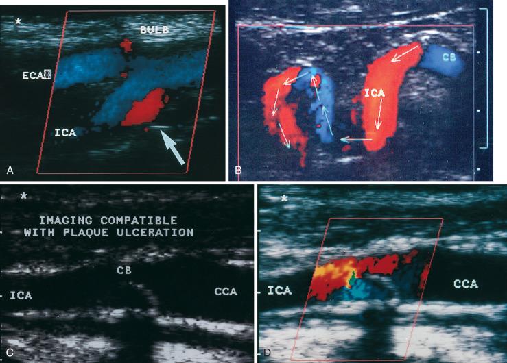 FIG 14.5, (A) Advantages of using color duplex scanning. Normal carotid bifurcation (CB) , illustrating the flow separation (reverse flow) occurring in the bulb opposite the flow divider during peak systole (arrow) . (B) Marked tortuosity of internal carotid artery (ICA) is easily demonstrated with color scan. (C) Conventional grayscale image does not provide clear identification of large ulcer. (D) Blood flow within plaque confirms the ulcer. (E) Pseudoaneurysm originating from the superficial femoral artery (SFA) resulting from catheterization. Note the bidirectional flow recorded in the neck. (F) Type 2 endoleak with flow detected in the aneurysm sac outside of prosthesis. (G) Longitudinal view of same aorta showing leak is posterior to graft. (H) Blood flow around partial occluding thrombus. (I) Thrombus extending into common femoral vein (CFV) consistent with a level 4 endothermal heat induced thrombus, seen 2 days after endovascular ablation of great saphenous vein (GSV) . CCA , Common carotid artery; CFA , common femoral artery; ECA, external carotid artery; SFJ , saphenofemoral junction.