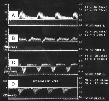 FIG 14.6, Vertebral artery Doppler waveforms.