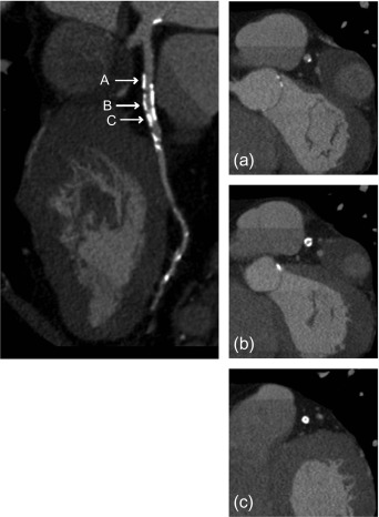 Figure 7.5, Coronary calcification and lumen evaluability. Curved multiplanar reformation (cMPR) of the left anterior descending (LAD) artery showing severe concentric calcification with blooming artifact and unevaluable lumen.