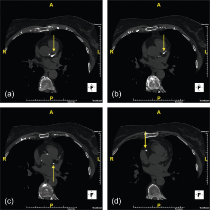 Figure 7.4, Coronary calcification and lumen evaluability. Noncontrast enhanced ECG-gated Cardiac CT, which demonstrates severe coronary artery calcification (arrows) of the left main (a), LAD (b), LCx (c), and RCA (d). In cases of severe coronary artery calcification, there is increased likelihood of nonevaluable coronary segments.