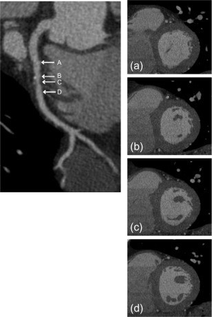 Figure 7.8, CTCA plaque imaging. Curved multiplanar reformation (cMPR) of the left anterior descending artery with a mixed plaque. (a)–(d) show cross sections: proximal to the plaque (a), inside the plaque lumen but proximal to its narrowest (b), plaque at its narrowest (c), and distal to the plaque (d).