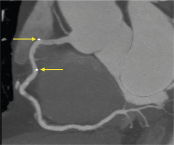 Figure 7.9, Bioresorbable scaffold imaged with CTCA. Curved multiplanar reformation (cMPR) of the right coronary artery containing a bioresorbable scaffold. Arrows illustrate the platinum markers of the device.