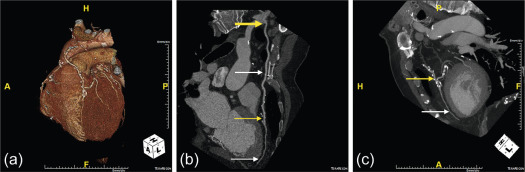 Figure 7.10, Coronary artery bypass graft imaging with CTCA. Image a: 3D Volume rendered image of the left internal thoracic artery (LITA) graft to left anterior descending (LAD). Graft evaluation included assessment of the graft origin (yellow thick arrow; Image b), graft body (white thin arrow; Image b), anastomotic site (yellow thin arrows; Images b and c), and distal run off (native distal LAD, images b and c, white thin arrow).