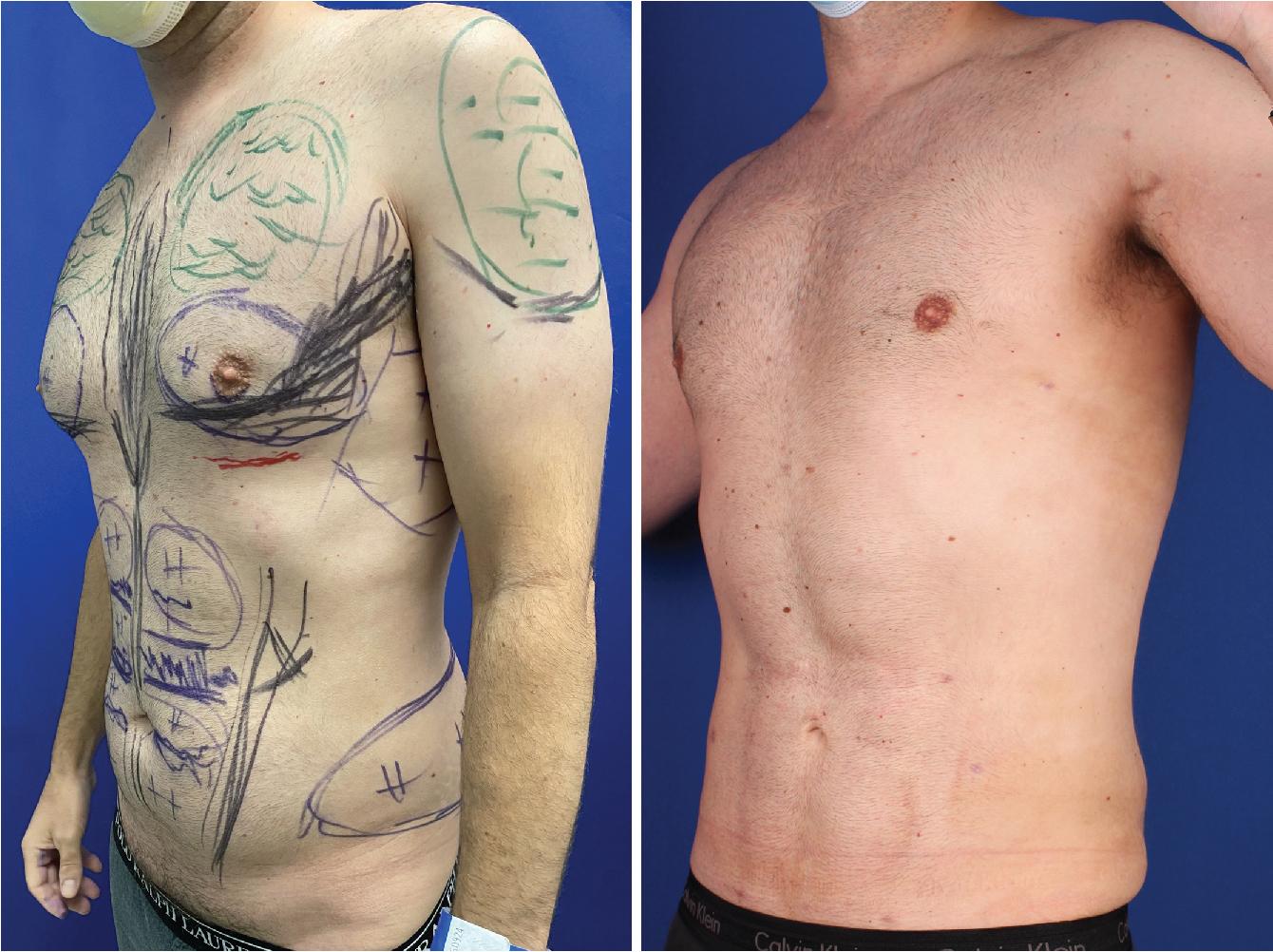 Fig. 8.1, A 44-year-old with body mass index of 25.1 kg/m 2 requests correction of his gynecomastia. COVID-19 restrictions have reduced his workouts and for the 7 pounds he has gained, he also requests body liposuction, improved muscular definition, and reluctantly accepts recommendation of pectoralis and deltoid muscle lipoaugmentation. Left anterior oblique views show before with surgical markings (left) and 3 months after (right) . VASERlipo, and syringe injection lipoaugmentation of filtered extract with 60 cc into each pectoralis and 35 cc into each deltoid muscle. After 2800 cc infusion of saline with 3 mg of epinephrine, 500 mg xylocaine into the abdomen (1000 cc), 10 min pulsed VASER followed with 5 ring probe at 80%, and then 600 cc aspiration through 3.7 mm. VentX cannula; into the flanks (600 cc), 6 min VASER followed and then 600 cc total aspiration; and into the chest (1200 cc), 12 min VASER followed with 1 ring at 80% and then 500 cc aspiration. From the aspirated 1700 cc, 190 cc of filtered fat was available for injection. An anticipated glandular pull through direct excision was not needed. Three months after (right) , the VASERlipo correction of the gynecomastia is complete with pleasing mid-pectoralis bulge and presternal vertical depression. The deltoid augmentation is not well seen. The rectus muscle is etched with a smooth transition to the pubis and no skin laxity. Subtle hip prominence appears in the wake of reduced flanks.