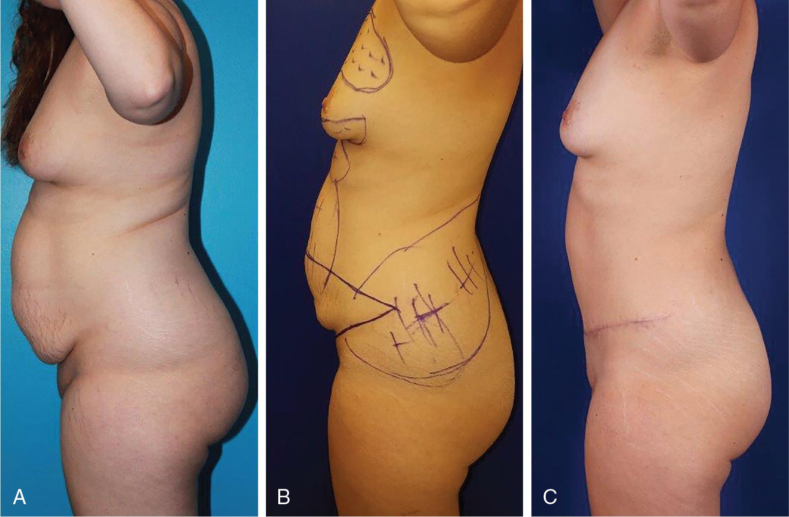 Fig. 8.2, Reduction of obesity with human choriogonadotropin (HCG)/500-calorie-a-day diet before lipoabdominoplasty and VASERlipo of the flanks as seen left lateral views. (A) Presentation of a 32-year-old with body mass index 31 kg/m 2 for abdominoplasty and repair of diastasis recti. (B) After 30-pound loss because of the diet, patient is marked for lipoabdominoplasty and VASERlipo of the flanks. Notable is the reduction of abdominal protuberance and absence of back rolls. (C) Two years after her lipoabdominoplasty, VASERlipo of the flanks and 150 cc lipoaugmentation of the breasts, her abdomen is flat and the flanks are hollowed.