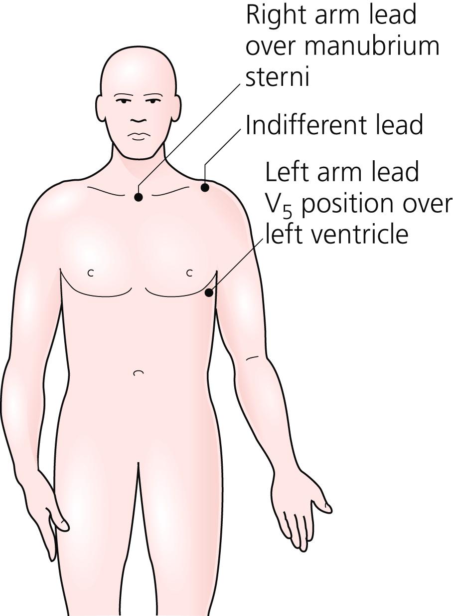 Fig. 10.6, The CM5 electrocardiogram lead configuration.