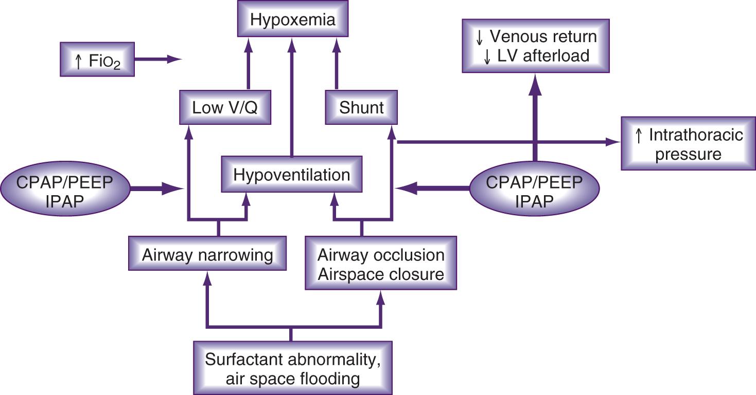 Fig. 55.1, Pathophysiology of acute hypercapnia and points where continuous positive airway pressure ( CPAP ), positive end-expiratory pressure ( PEEP ), and pressure support (PS) interrupt the process (large arrows). Hypercapnia (increased partial pressure of carbon dioxide in arterial blood [PaCO 2 ]) occurs when respiratory muscles fail to ventilate alveoli adequately to maintain homeostasis with carbon dioxide production. Respiratory muscle failure occurs when the work of breathing is normal (e.g., acute or chronic neuromuscular disease) or increased (e.g., patients with chronic obstructive pulmonary disease, asthma, or obesity hypoventilation syndrome), presumably because of inadequate oxygen delivery to the respiratory muscles (e.g., approximately one-third of patients presenting with cardiogenic pulmonary edema). Strategies to counter these pathophysiologic mechanisms include applying CPAP or PEEP to counterbalance intrinsic PEEP (PEEPi), increasing alveolar ventilation by augmenting tidal volume (V t ), using intermittent positive-pressure ventilation (IPPV), and reducing CO 2 production by decreasing the work of breathing. FiO 2 , Fraction of inspired oxygen; IPAP , inspiratory positive airway pressure; LV , left ventricular.