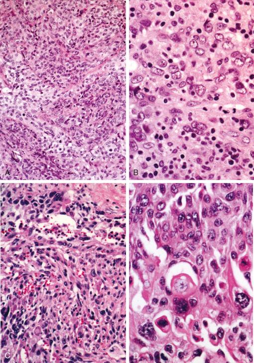 Figure 59-1, Histologic categories of metastatic tumor in lymph node.