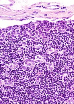 Figure 59-2, Metastatic lobular carcinoma of the breast.