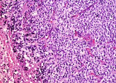 Figure 59-3, Metastatic rhabdomyosarcoma.