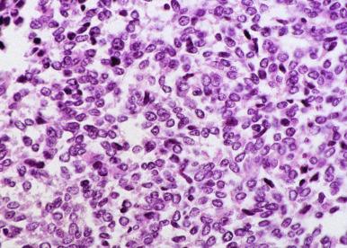 Figure 59-4, Metastatic Ewing's sarcoma/primitive neuroectodermal tumor.