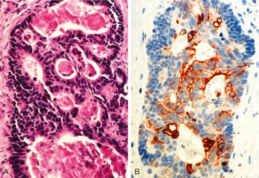 Figure 59-6, Keratin immunostaining of colon adenocarcinoma metastatic to lymph node.