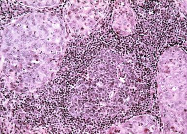 Figure 59-7, Metastatic non-keratinizing squamous cell carcinoma of nasopharyngeal origin.
