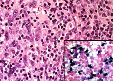 Figure 59-8, Metastatic undifferentiated nasopharyngeal carcinoma—Schmincke or lymphoepithelioma type.