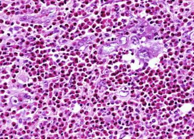 Figure 59-9, Metastatic undifferentiated nasopharyngeal carcinoma—eosinophil-rich variant.