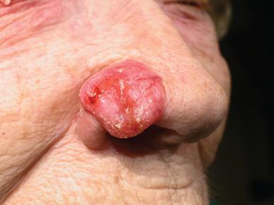 Figure 67.2, Typical presentation of basal cell carcinoma on the nose.