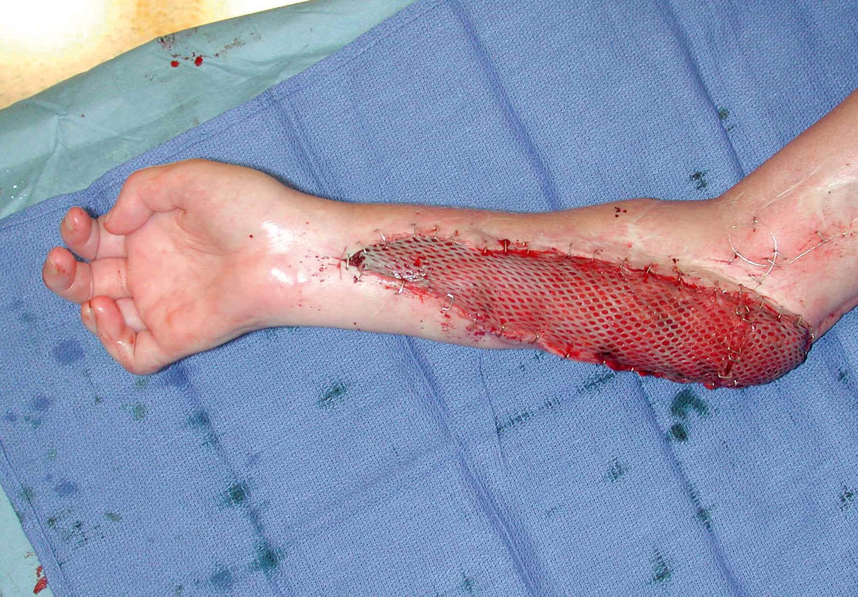 Fig. 44.6, A meshed split-thickness graft placed over an innervated gracilis muscle to the forearm.