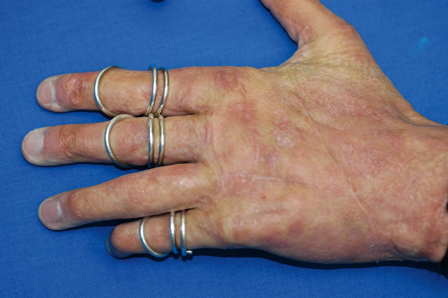 Fig. 44.9, Hand of a patient who suffered burns of the hands and was treated with excision and primary split-thickness sheet grafting. Note quality of dorsal hand skin after placement of sheet graft.