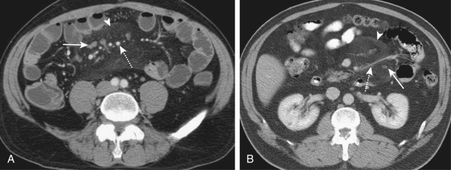 Figure 82-1, Mesenteric panniculitis. Contrast-enhanced axial computed tomography images in a 52-year-old woman with abdominal pain (A) and a 58-year-old man with known lung cancer (B). In both cases, the root of the mesentery is expanded and has a misty appearance (arrowheads). There are small lymph nodes (arrows) with a ring of low-density fat around them (“fat ring” sign). The mesenteric vessels (dashed arrows) have increased density fat around them but are not stenosed.