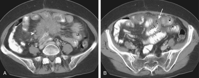 Figure 82-2, Retractile mesenteritis. A 71-year-old woman presented with nausea and abdominal pain. A, Axial computed tomography (CT) image shows a 5-cm soft tissue mass (arrowhead) in the mesentery with spiculated outline and indrawing and tethering of small bowel loops. B, Axial CT image shows thick-walled small bowel (arrow). The patient underwent laparotomy and was found to have ischemic small bowel, which was resected. The differential diagnosis for the CT finding includes carcinoid tumor and desmoid.