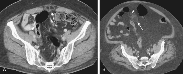 Figure 82-3, Epiploic appendagitis. Axial computed tomography images in a 50-year-old woman undergoing staging for known breast cancer (A) and a 69-year-old man with pelvic pain (B). Epiploic appendagitis appears as a fat density ovoid lesion with peripheral soft tissue rim (arrows). There may be central hyperdensity as a result of a thrombosed epiploic vein ( arrowhead, B ). The lesions are found on the antimesenteric border of the colon, usually anterior or lateral to the colon. The colonic wall is not thickened. Epiploic appendagitis is usually less than 5 cm and does not have mass effect.