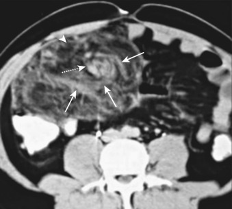 Figure 82-5, Omental torsion. Axial computed tomography image in a 39-year-old woman with acute right lower quadrant pain. The omentum is swollen (arrowhead) with a central hyperdense structure (dashed arrow) and whirling pattern of curvilinear streaks (solid arrows). The appearance is classic for omental torsion. The patient was managed conservatively.