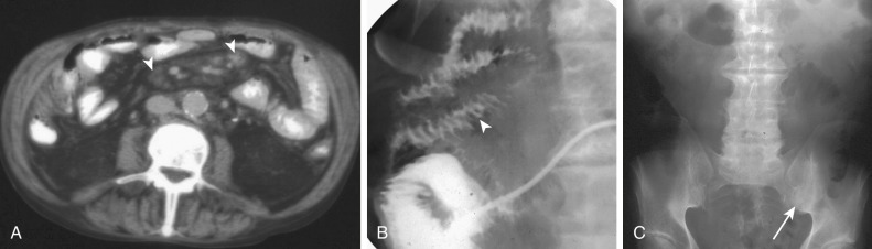 Figure 82-6, Whipple's disease in a 62-year-old man with unexplained fever and weight loss. A, Axial computed tomography shows mixed low-density and higher density mesenteric adenopathy (arrowheads). This was initially thought to be due to lymphoma. B, Small bowel follow-through was performed for investigation of concomitant malabsorption. There is evidence of fold and wall thickening (arrowhead) of the small bowel. C, Abdominal radiograph on same patient shows asymmetric sacroiliitis, worse on the left (arrow). Whipple's disease is a cause of seronegative spondyloarthropathy.