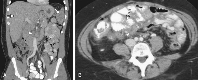 Figure 82-8, Abdominal sarcoidosis. A, A 43-year-old man presented with known sarcoidosis. Coronal reformatted abdominal computed tomography image shows numerous small low-density lesions in the liver and spleen (arrows), as well as moderate-volume adenopathy (arrowhead). These findings remained stable over 3.5 years of follow-up. They are consistent with sarcoidosis and represent the most common presentation of this disease in the abdomen. B, A 48-year-old woman presented with known sarcoidosis and abdominal cramping. Axial computed tomography shows dense mesenteric soft tissue (arrowhead) enveloping bowel loops, which show thickened folds (arrow). The peritoneal biopsy showed noncaseating granuloma.