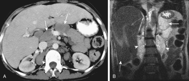 Figure 82-9, Extramedullary hematopoiesis in a 16-year-old girl with homozygous sickle cell anemia. Axial computed tomography scan (A) and coronal T2-weighted magnetic resonance image (B) show several peritoneal masses of low density and high signal intensity (solid arrows) around the celiac artery and the hepatic hilum and retroperitoneal masses (arrowheads). These simulate lymphadenopathy. However, in this patient the lesions were foci of extramedullary hematopoiesis. Note the absence of spleen from autosplenectomy and moderately enlarged liver ( dashed arrow, B ).