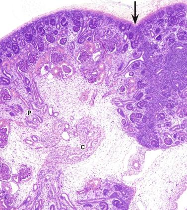 Fig. 1.13, Kidney from a 13-week fetus (compare with Fig. 1.14 ) showing a renal lobe with a pyramid ( P ) and the collecting system ( C ). Fusion of adjacent lobes forms columns of Bertin ( arrow ).