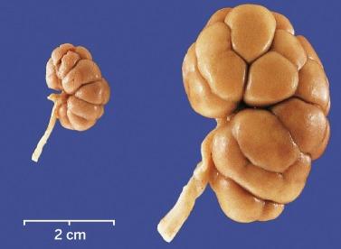 Fig. 1.15, A 22-week fetal kidney ( left ) and a 40-week term kidney ( right ) showing distinct fetal lobes.