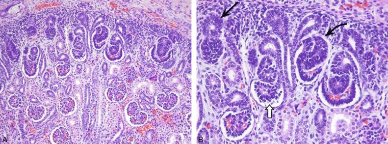 Fig. 1.17, (A) Nephrogenic zone of a 14-week kidney. (B) Notice the ampullary bud and hollow vesicles ( arrow ), early S-phase ( curved arrow ), primitive glomerular tuft ( open arrow ), and increasingly mature glomeruli.