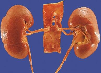 Fig. 1.20, Kidneys showing two grooves defining the renal poles.