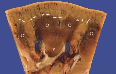 Fig. 1.21, This renal lobe shows the cortical medullary rays. The columns of Bertin invest the outer medulla ( O ), whereas the papilla ( P ) or inner medulla is nestled within a minor calyx.