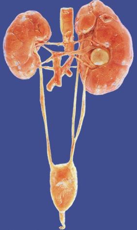 Fig. 1.26, A duplex left kidney with a bifid ureter and a nonrotated (anterior) lower pelvis. An inferior supernumerary artery and a normal vein cross the ureter, with resulting ureteropelvic junction obstruction.