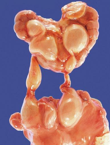 Fig. 1.28, Horseshoe kidney showing hydroureteronephrosis from a neonate with trisomy 18 and multiple congenital anomalies.