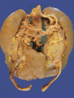 Fig. 1.29, Horseshoe kidney as an incidental autopsy finding in an adult.